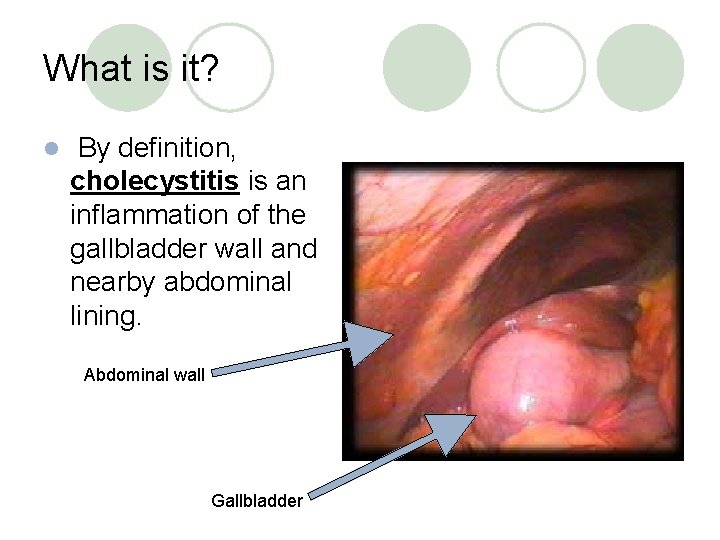 What is it? l By definition, cholecystitis is an inflammation of the gallbladder wall