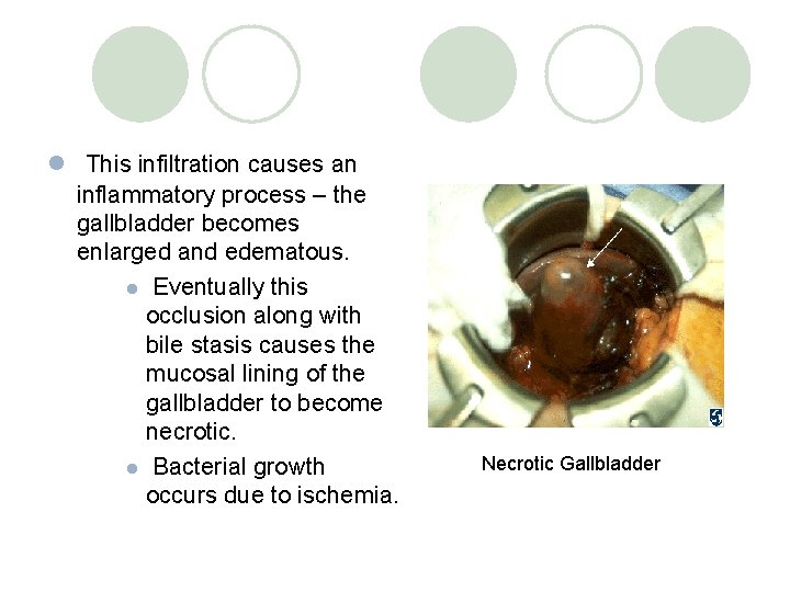 l This infiltration causes an inflammatory process – the gallbladder becomes enlarged and edematous.