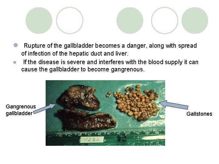 l Rupture of the gallbladder becomes a danger, along with spread of infection of