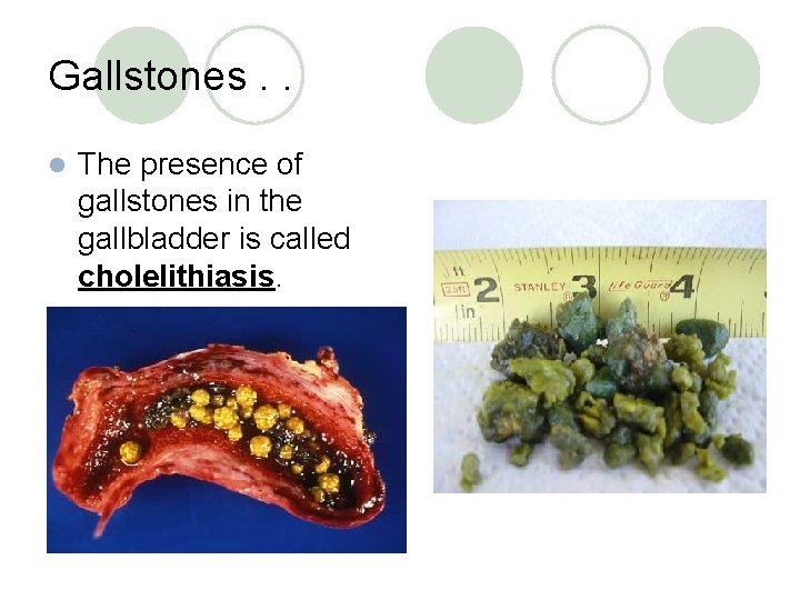 Gallstones. . l The presence of gallstones in the gallbladder is called cholelithiasis. 