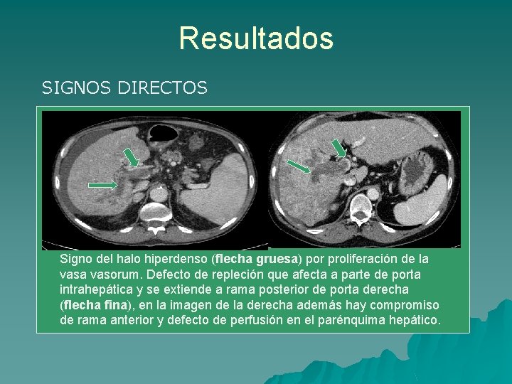 Resultados SIGNOS DIRECTOS Signo del halo hiperdenso (flecha gruesa) por proliferación de la vasorum.