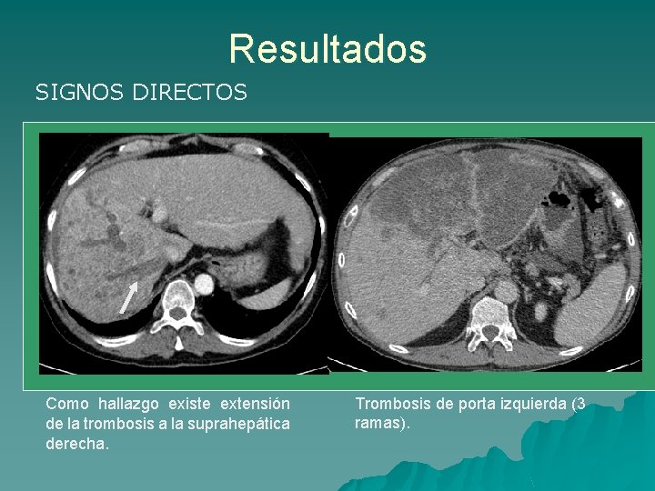 Resultados SIGNOS DIRECTOS Como hallazgo existe extensión de la trombosis a la suprahepática derecha.