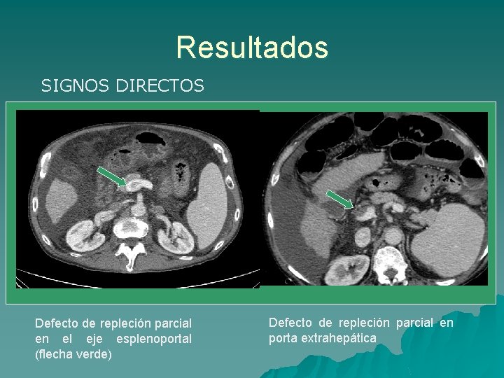Resultados SIGNOS DIRECTOS Defecto de repleción parcial en el eje esplenoportal (flecha verde) Defecto