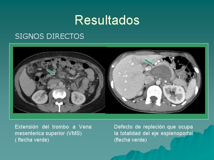 Resultados SIGNOS DIRECTOS Extensión del trombo a Vena mesenterica superior (VMS) ( flecha verde)