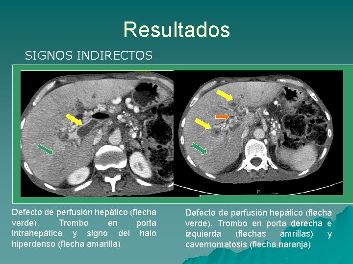 Resultados SIGNOS INDIRECTOS Defecto de perfusión hepático (flecha verde). Trombo en porta intrahepática y