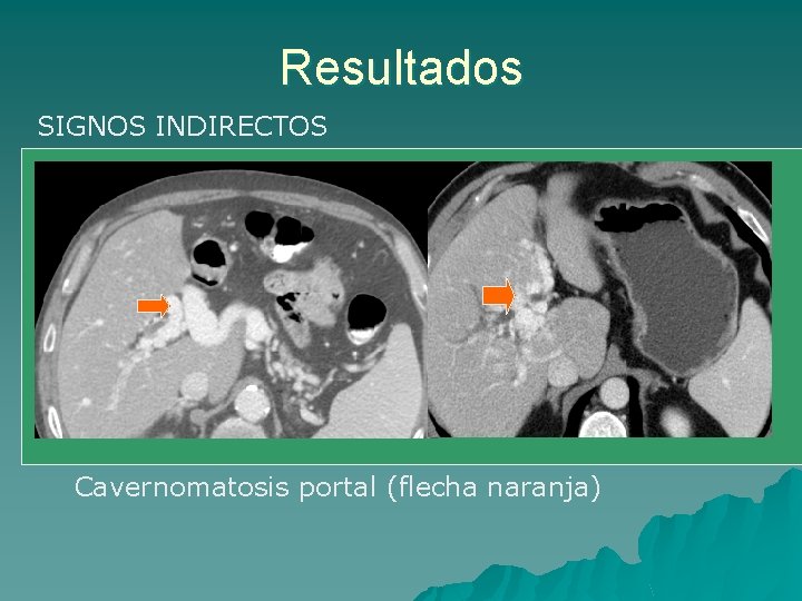 Resultados SIGNOS INDIRECTOS Cavernomatosis portal (flecha naranja) 