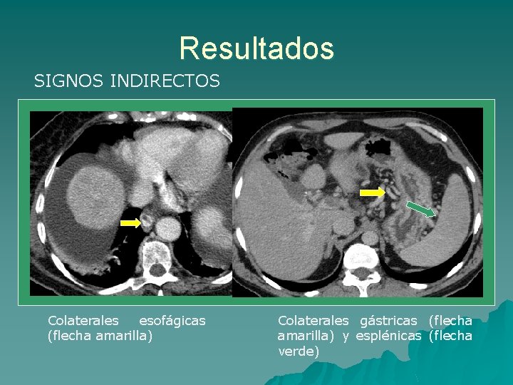 Resultados SIGNOS INDIRECTOS Colaterales esofágicas (flecha amarilla) Colaterales gástricas (flecha amarilla) y esplénicas (flecha