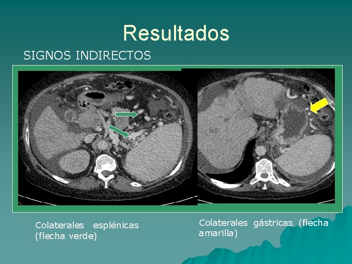 Resultados SIGNOS INDIRECTOS Colaterales esplénicas (flecha verde) Colaterales gástricas (flecha amarilla) 