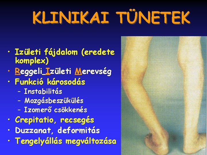 KLINIKAI TÜNETEK • Izületi fájdalom (eredete komplex) • Reggeli Izületi Merevség • Funkció károsodás