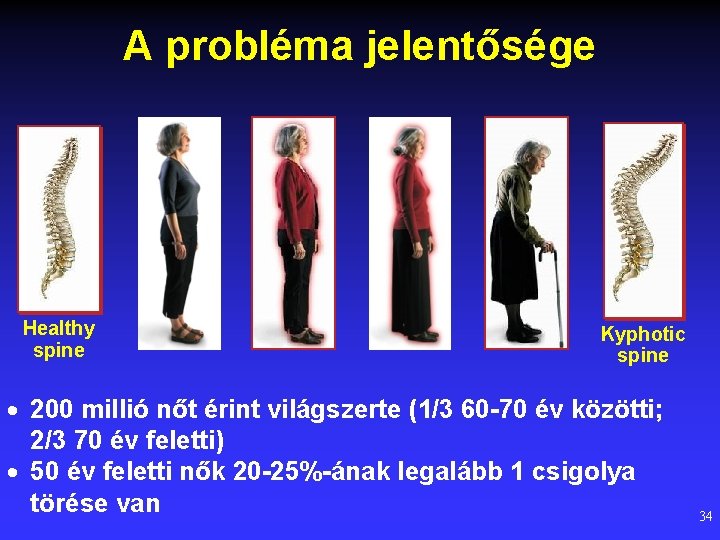 A probléma jelentősége Healthy spine Kyphotic spine · 200 millió nőt érint világszerte (1/3