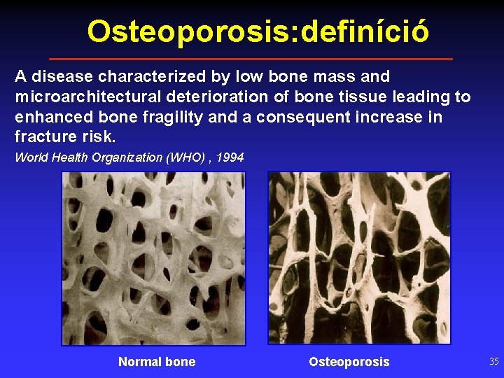 Osteoporosis: definíció A disease characterized by low bone mass and microarchitectural deterioration of bone