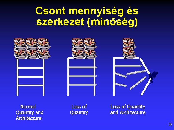 Csont mennyiség és szerkezet (minőség) Normal Quantity and Architecture Loss of Quantity and Architecture