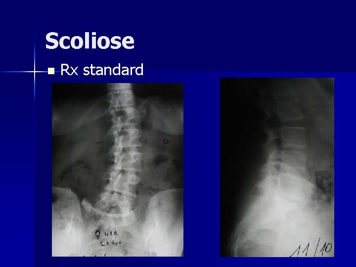 Scoliose n Rx standard 