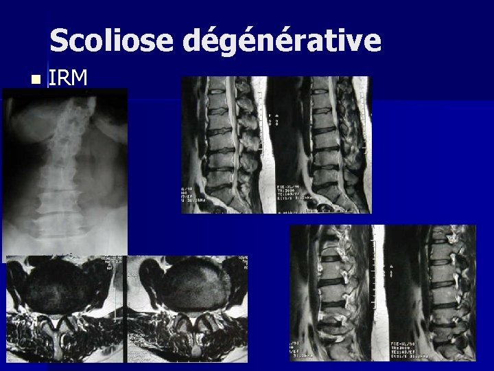 Scoliose dégénérative n IRM 