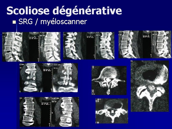 Scoliose dégénérative n SRG / myéloscanner 