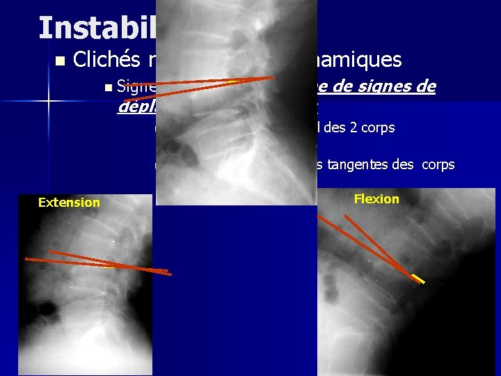 Instabilité n Clichés radiologiques dynamiques n Signes directes: Recherche de signes de déplacement vertébral