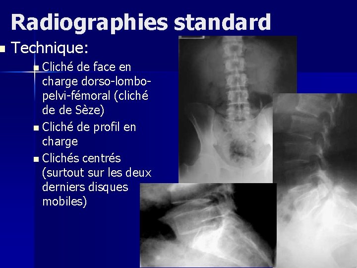 n Radiographies standard Technique: n Cliché de face en charge dorso-lombopelvi-fémoral (cliché de de