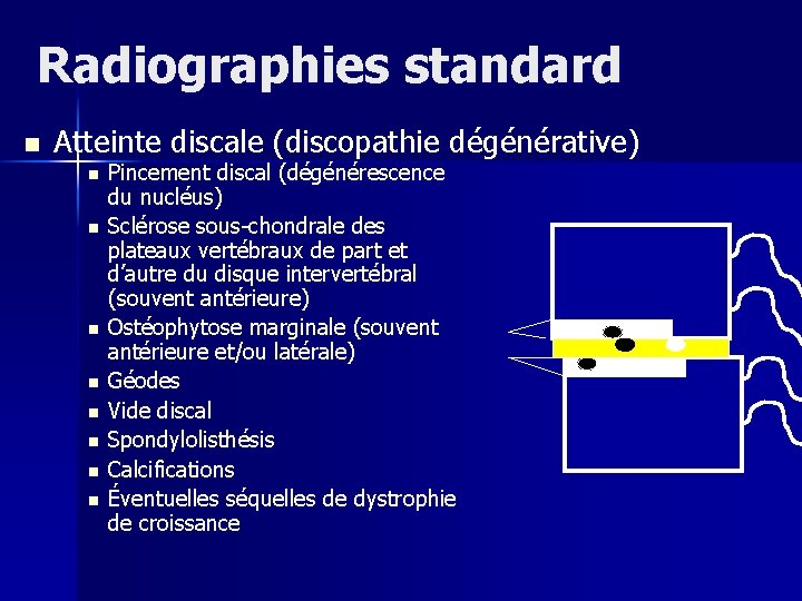 Radiographies standard n Atteinte discale (discopathie dégénérative) n n n n Pincement discal (dégénérescence