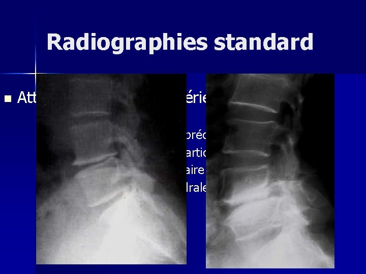 Radiographies standard n Atteinte articulaire postérieure n Clichés de profil n Difficile à apprécier