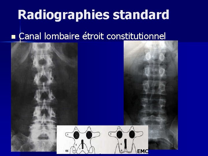 Radiographies standard n Canal lombaire étroit constitutionnel EMC 