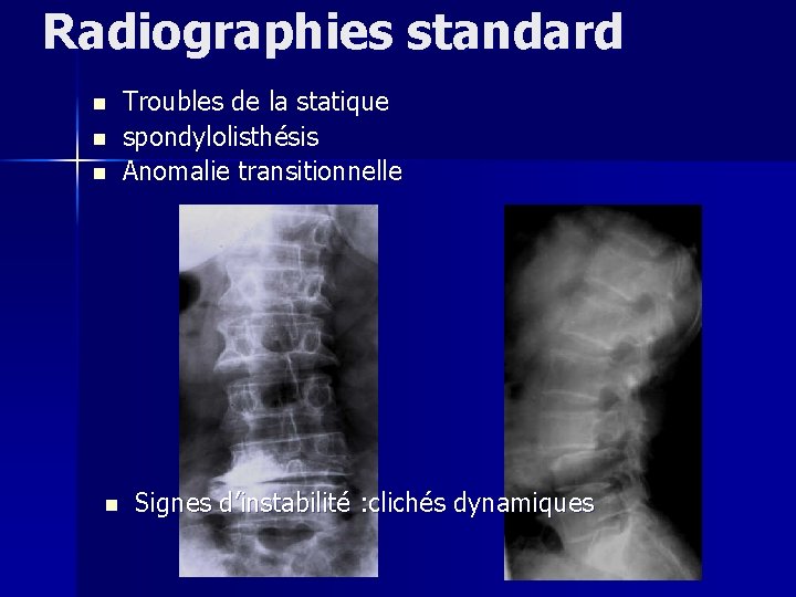 Radiographies standard n n Troubles de la statique spondylolisthésis Anomalie transitionnelle Signes d’instabilité :