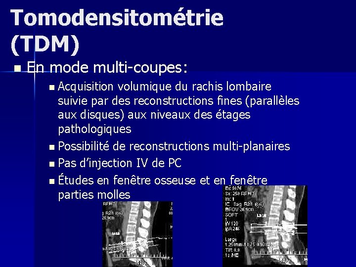 Tomodensitométrie (TDM) n En mode multi-coupes: n Acquisition volumique du rachis lombaire suivie par