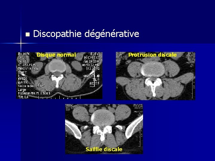 n Discopathie dégénérative Disque normal Protrusion discale Saillie discale 