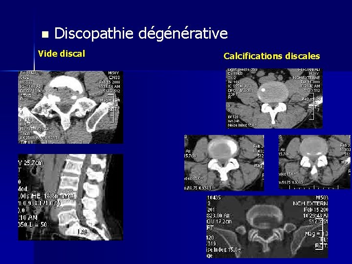 n Discopathie dégénérative Vide discal Calcifications discales 