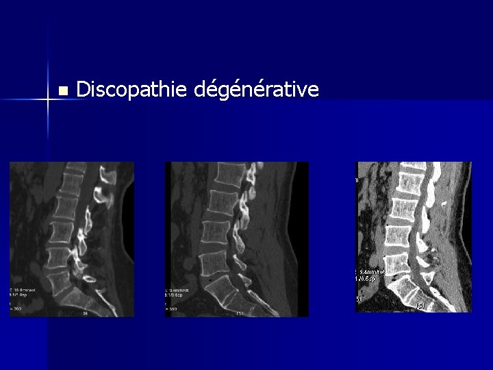 n Discopathie dégénérative 