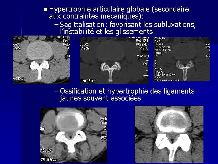 n Hypertrophie articulaire globale (secondaire aux contraintes mécaniques): – Sagittalisation: favorisant les subluxations, l’instabilité