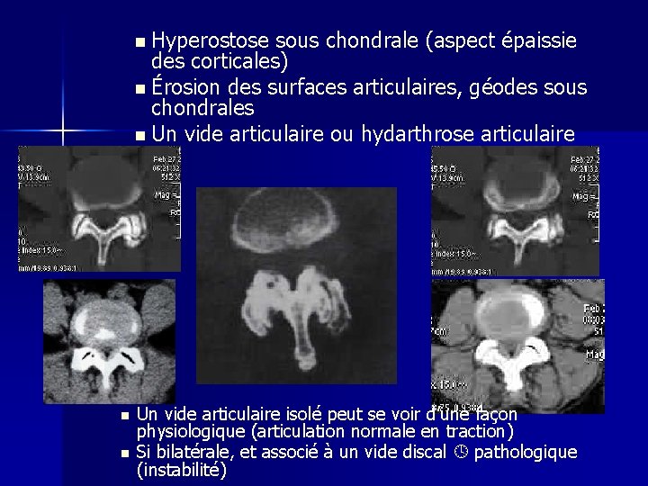 n Hyperostose sous chondrale (aspect épaissie des corticales) n Érosion des surfaces articulaires, géodes