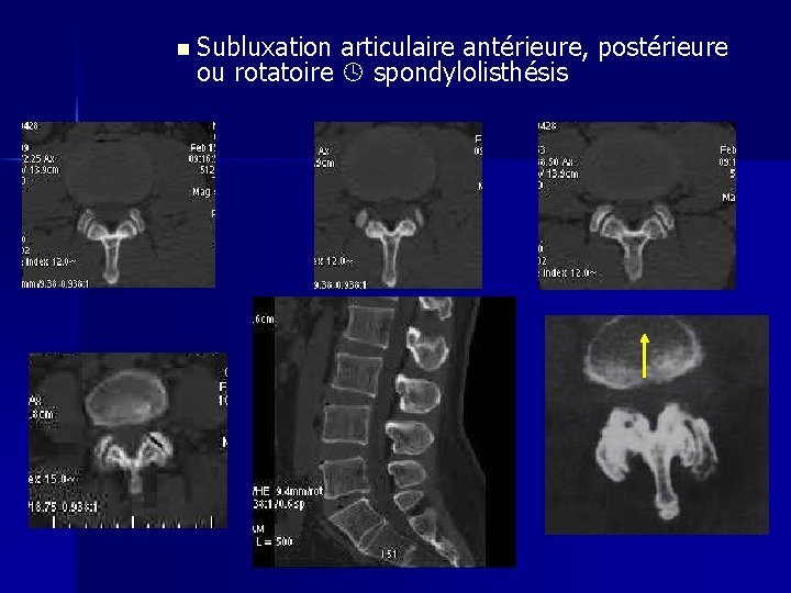 n Subluxation articulaire antérieure, postérieure ou rotatoire spondylolisthésis 