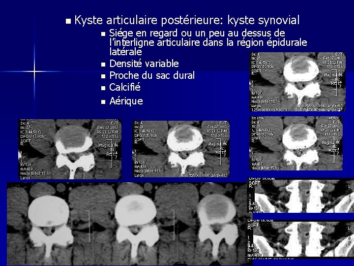 n Kyste articulaire postérieure: kyste synovial n n n Siége en regard ou un