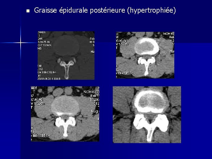 n Graisse épidurale postérieure (hypertrophiée) 