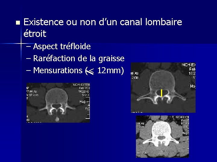 n Existence ou non d’un canal lombaire étroit – Aspect tréfloide – Raréfaction de