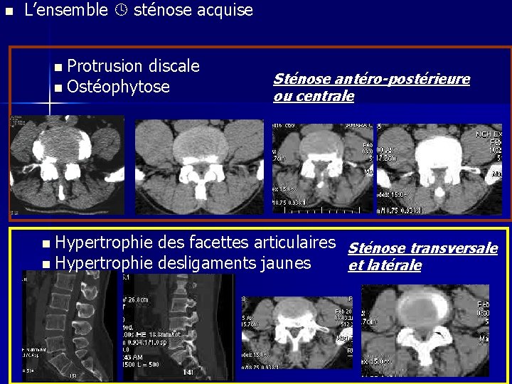 n L’ensemble sténose acquise n Protrusion discale n Ostéophytose n Hypertrophie Sténose antéro-postérieure ou