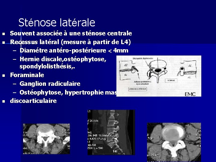 Sténose latérale n n Souvent associée à une sténose centrale Recessus latéral (mesure à
