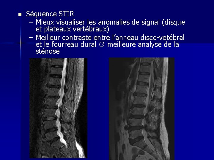 n Séquence STIR – Mieux visualiser les anomalies de signal (disque et plateaux vertébraux)