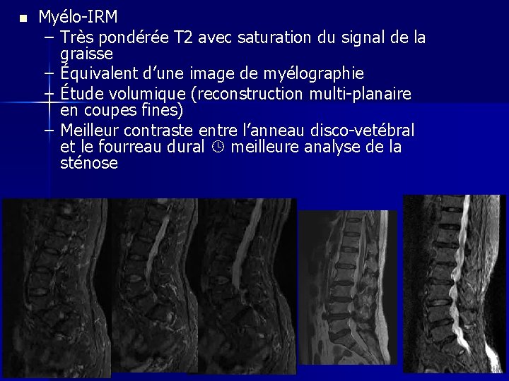 n Myélo-IRM – Très pondérée T 2 avec saturation du signal de la graisse