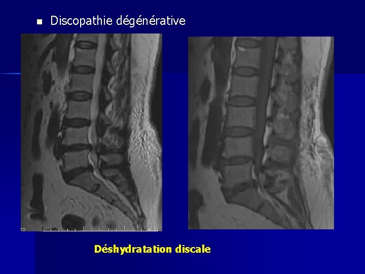 n Discopathie dégénérative Déshydratation discale 