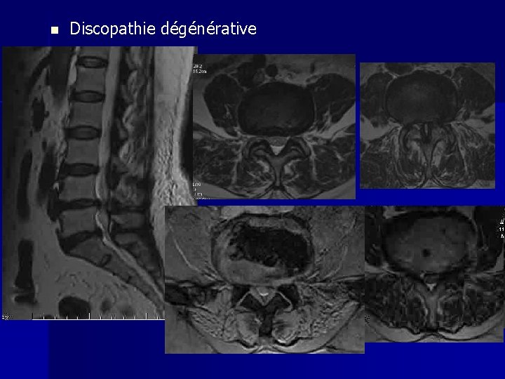 n Discopathie dégénérative 