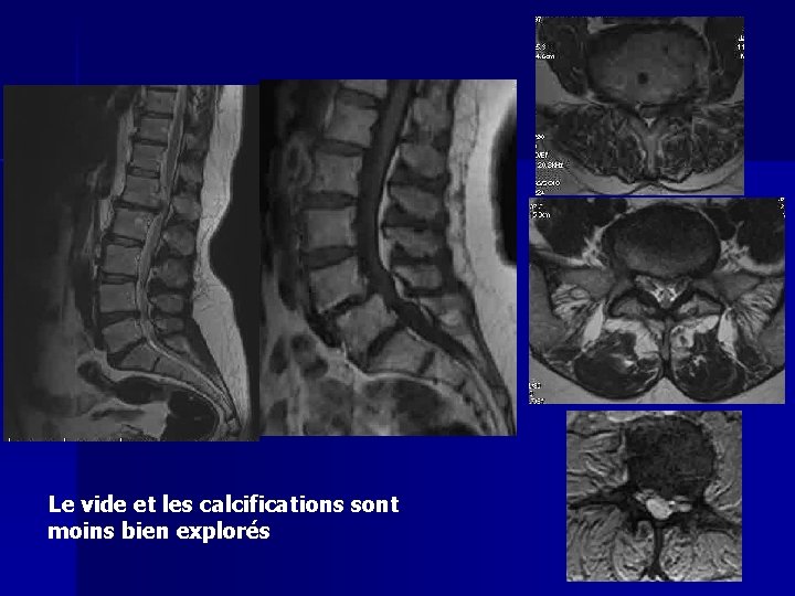 Le vide et les calcifications sont moins bien explorés 