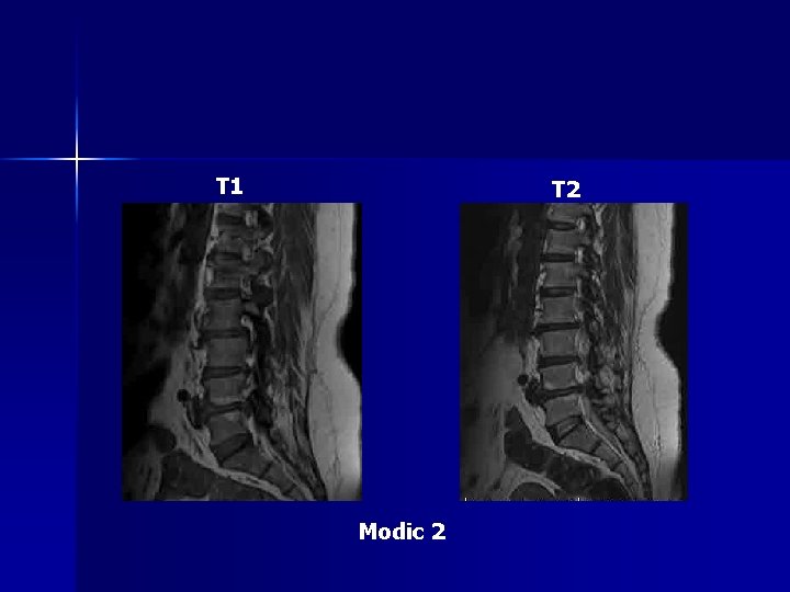 T 1 T 2 Modic 2 