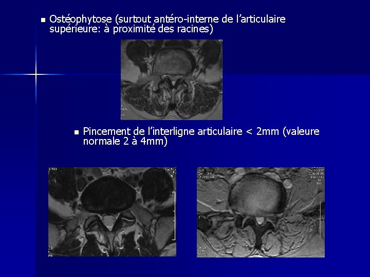 n Ostéophytose (surtout antéro-interne de l’articulaire supérieure: à proximité des racines) n Pincement de