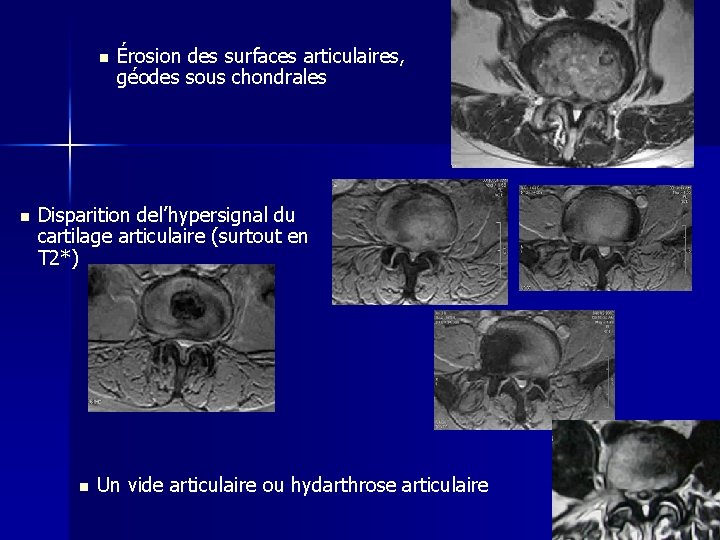 n n Érosion des surfaces articulaires, géodes sous chondrales Disparition del’hypersignal du cartilage articulaire