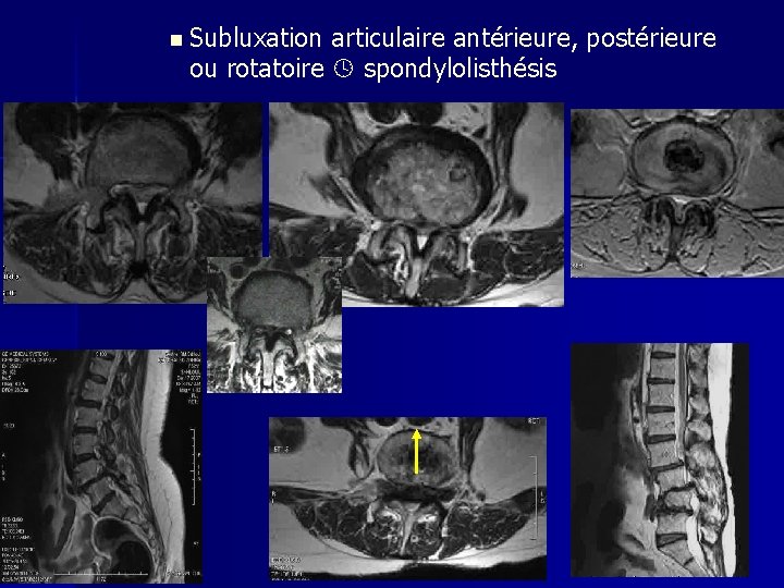 n Subluxation articulaire antérieure, postérieure ou rotatoire spondylolisthésis 