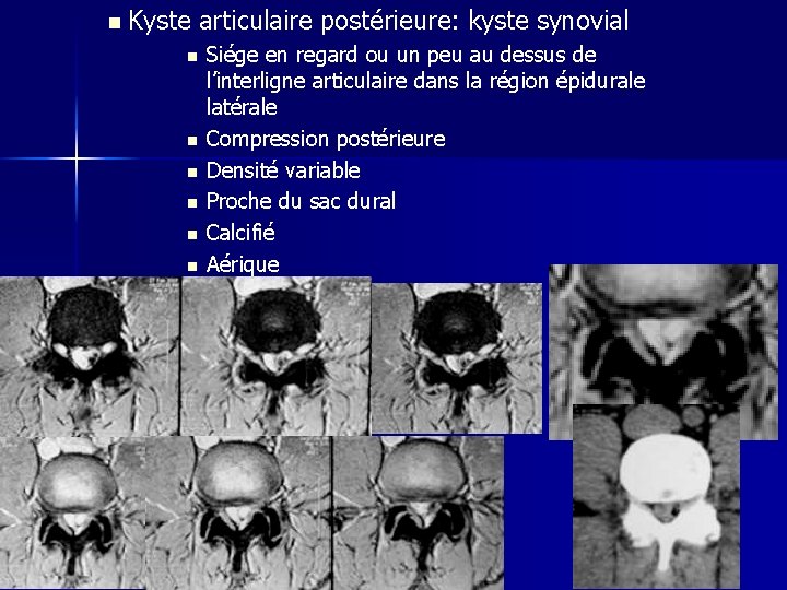 n Kyste articulaire postérieure: kyste synovial n n n Siége en regard ou un