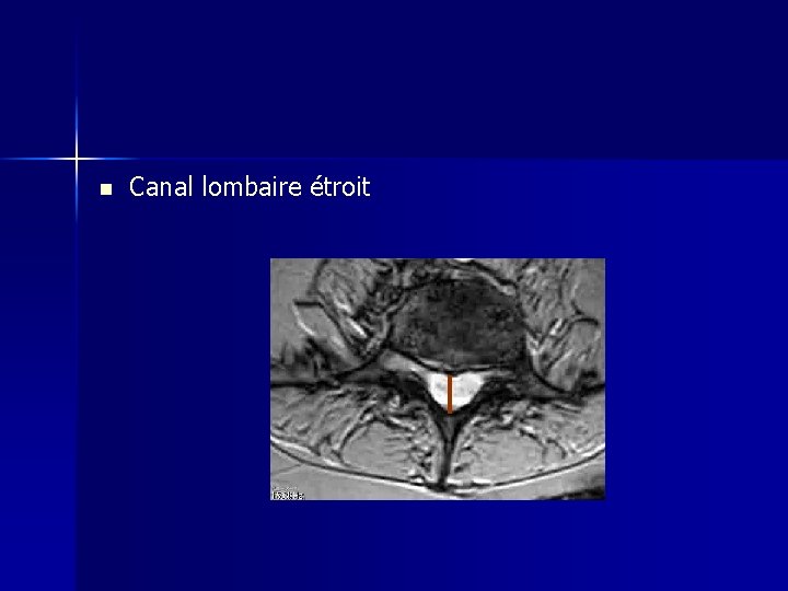 n Canal lombaire étroit 