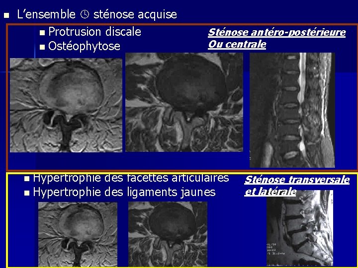 n L’ensemble sténose acquise n Protrusion discale n Ostéophytose n Hypertrophie Sténose antéro-postérieure Ou