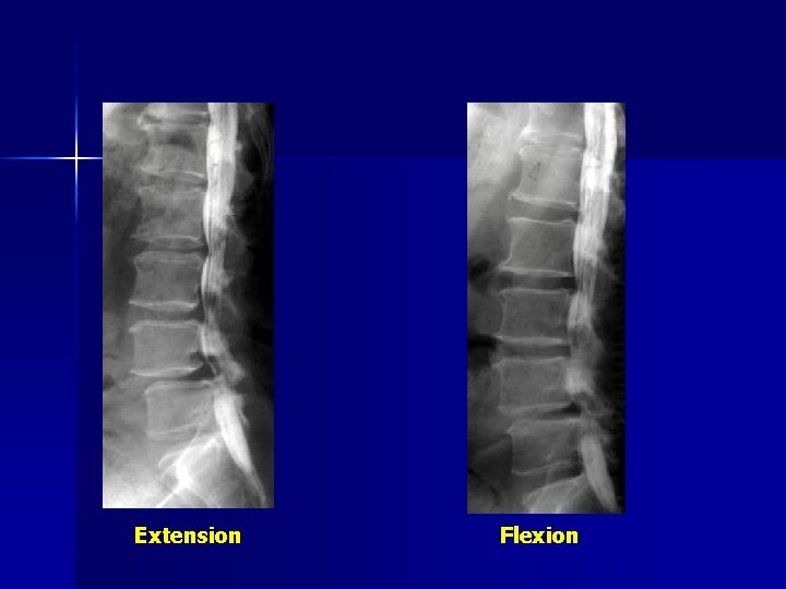 Extension Flexion 